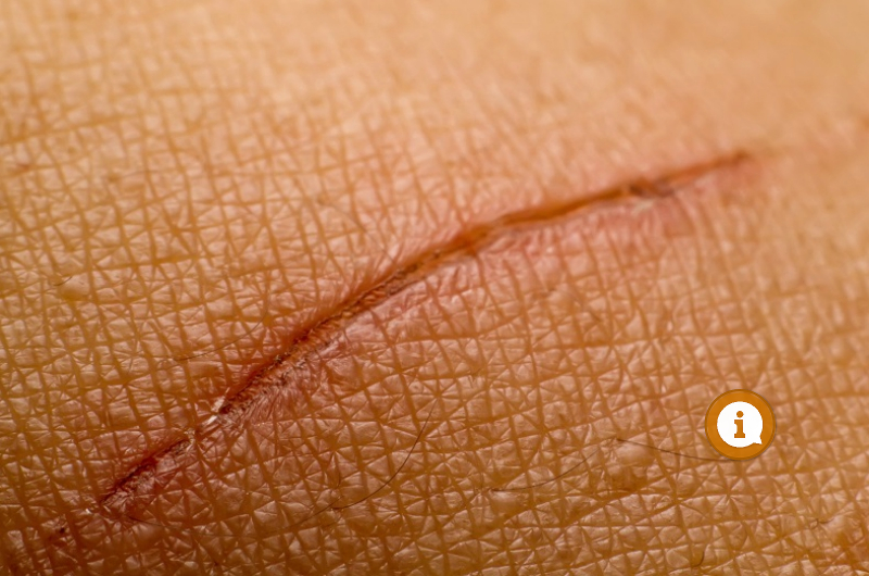 Preventsabnormalscarringbefore_800x530